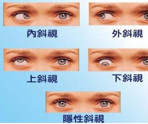 造成斜视的原因，斜视，眉山眼耳鼻咽喉医院，眼科专家，.png