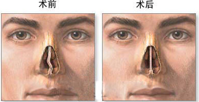 鼻中隔偏曲，鼻窦，腺样体肥大，鼻息肉，流鼻血.png